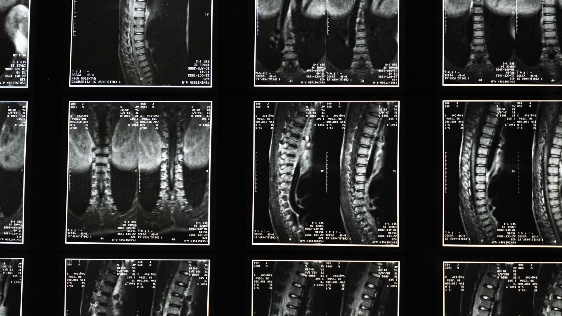 Radiografias de coluna em negatoscópio, ilustrando a perícia que descreve a deformidade e fixa o percentual de incapacidade